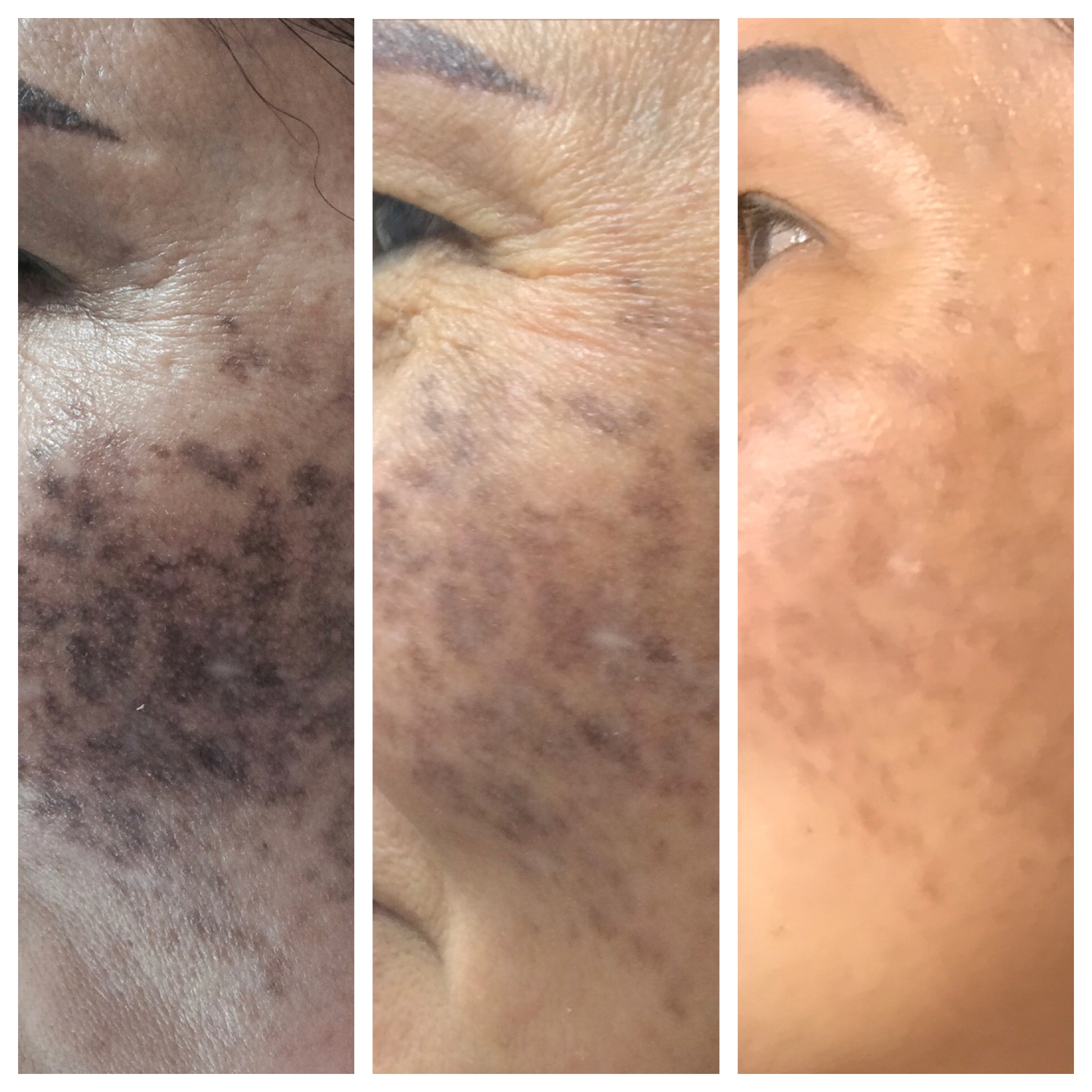 Dark Spot Removal Before and After